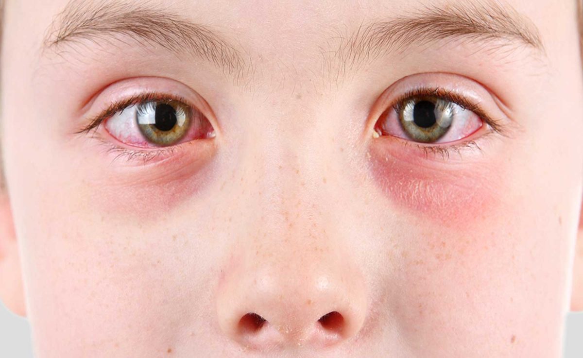 conjuntivitis en los niños