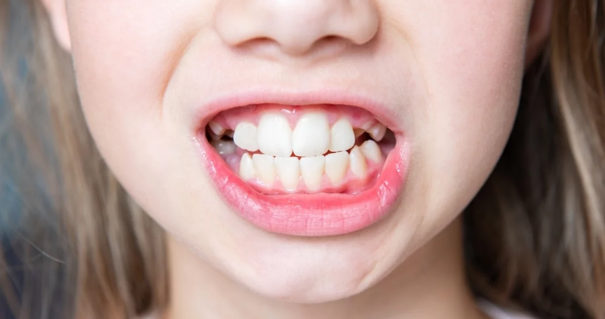 Hablará peor mi hijo si tiene los dientes mal alineados